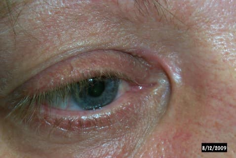 Lower eyelid retraction with scleral show after blepharoplasty