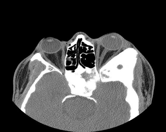 CT scan โ fibrous dysplasia expanding the orbital bone, with the characteristic hazy โground-glassโ matrix