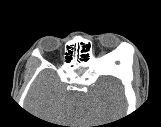 CT of orbital fibrous dysplasia โ expanded ground-glass bone