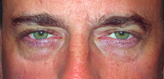 Patient 1 — before