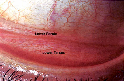 Cosmetic & Reconstructive Facial Eyelid & Orbital surgery @ Eye Plastics.